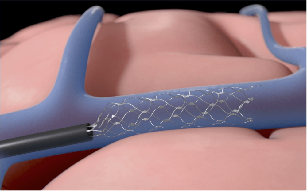 Thiết bị Stentrode được cấy vào não người dùng. Ảnh: NeuroNews